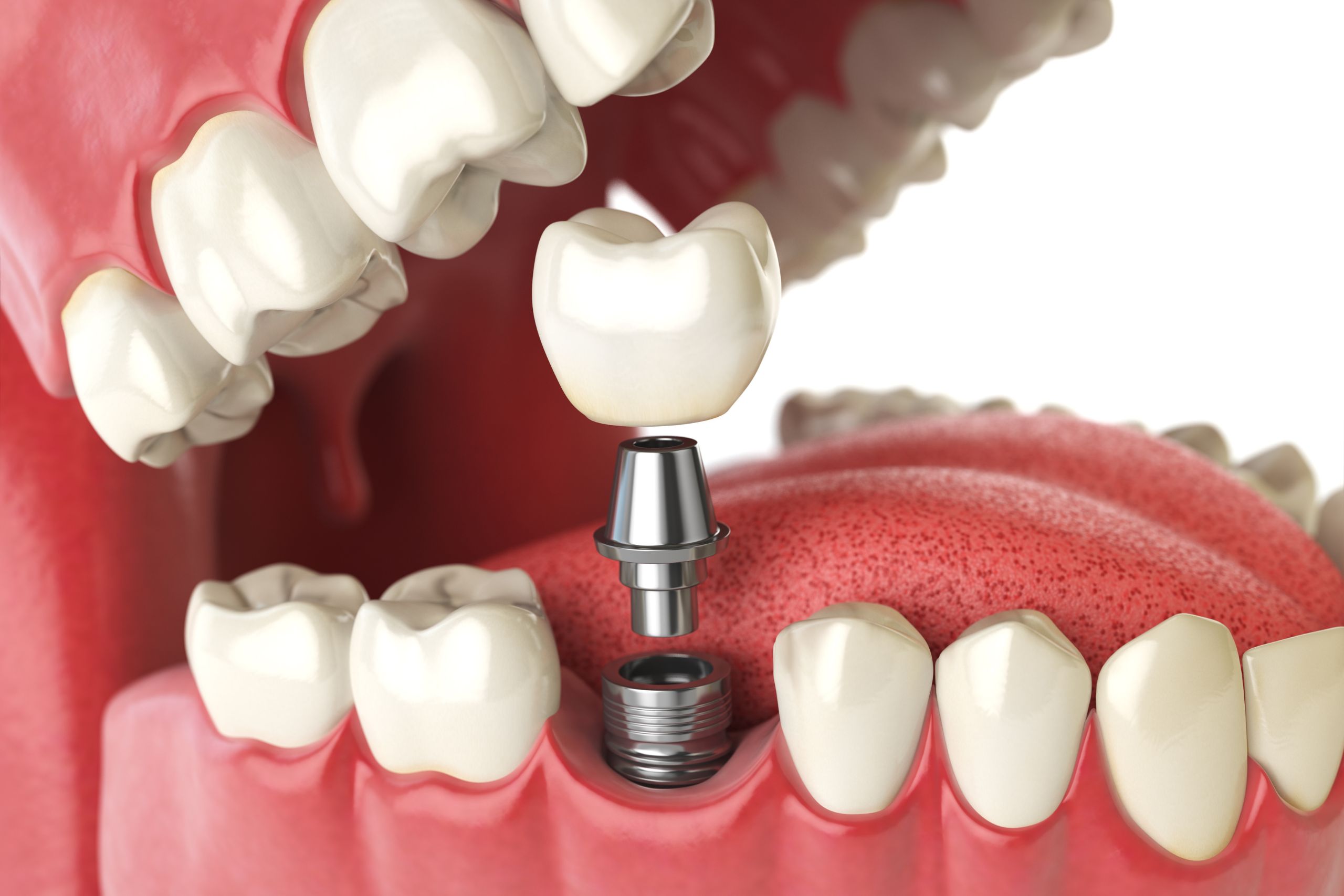 Dental Implants Tupelo MS