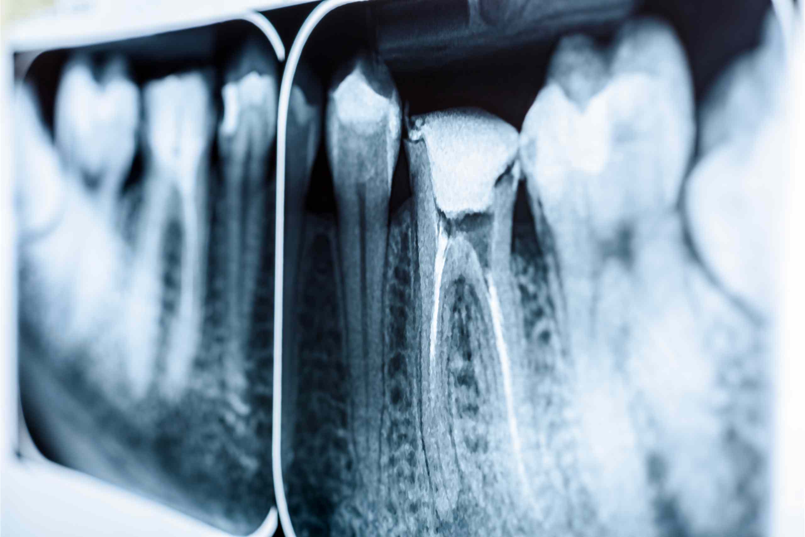 Root Canal Treatment Tupelo MS
